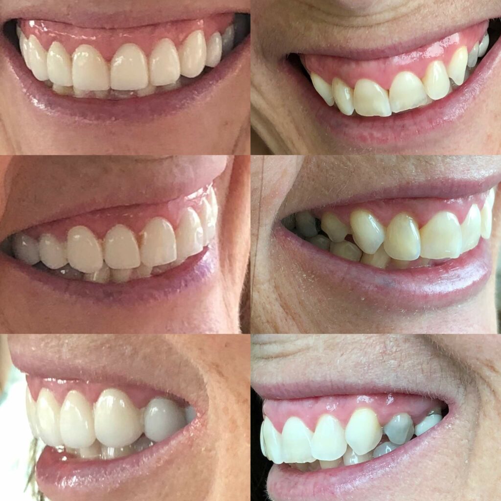 Smile Gallery. Dentist in Phoenix, AZ. Dr. Mike Hall. Hall Dental