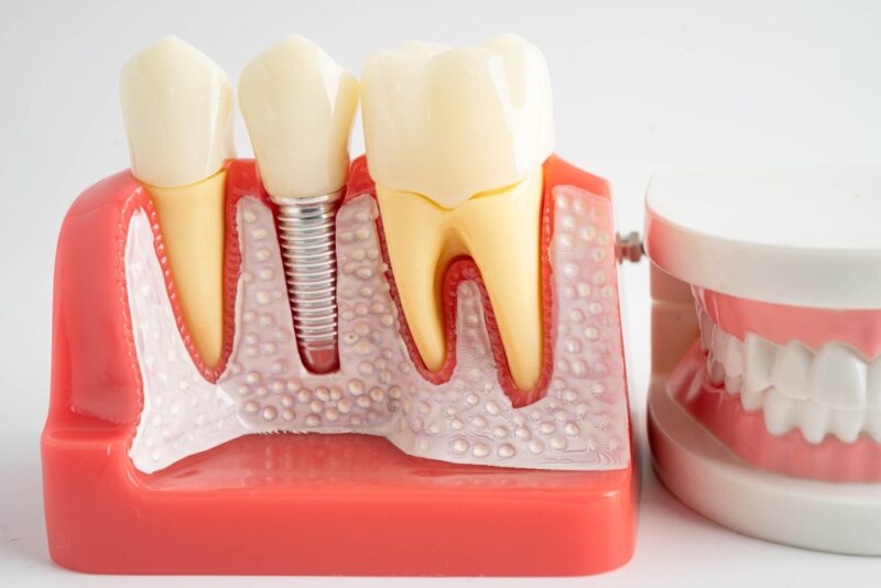 How long do dental implants last?