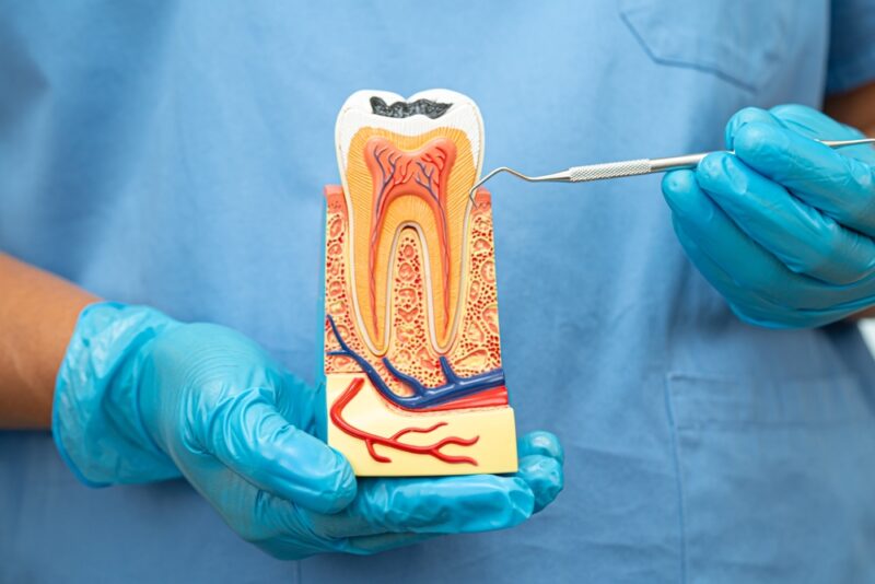 Root Canal Treatment in Phoenix