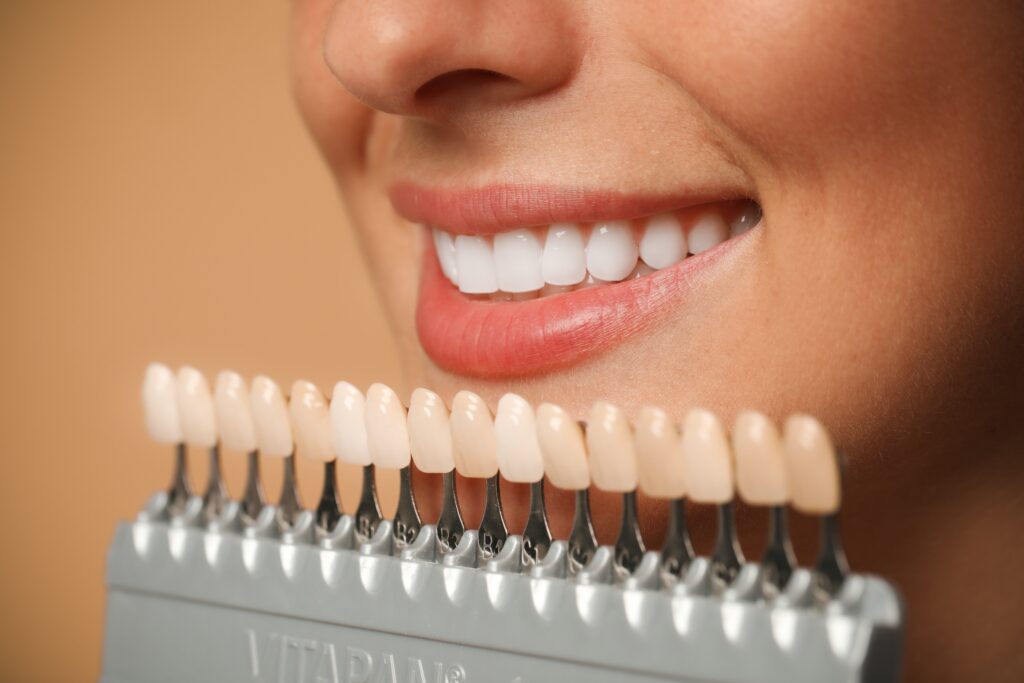 Dental Veneers Phoenix